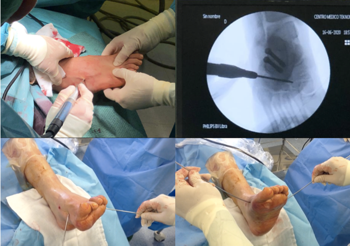 pie-cavo-varo-infantil-uca